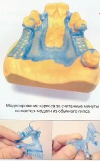 Модель для изготовления бюгельного протеза