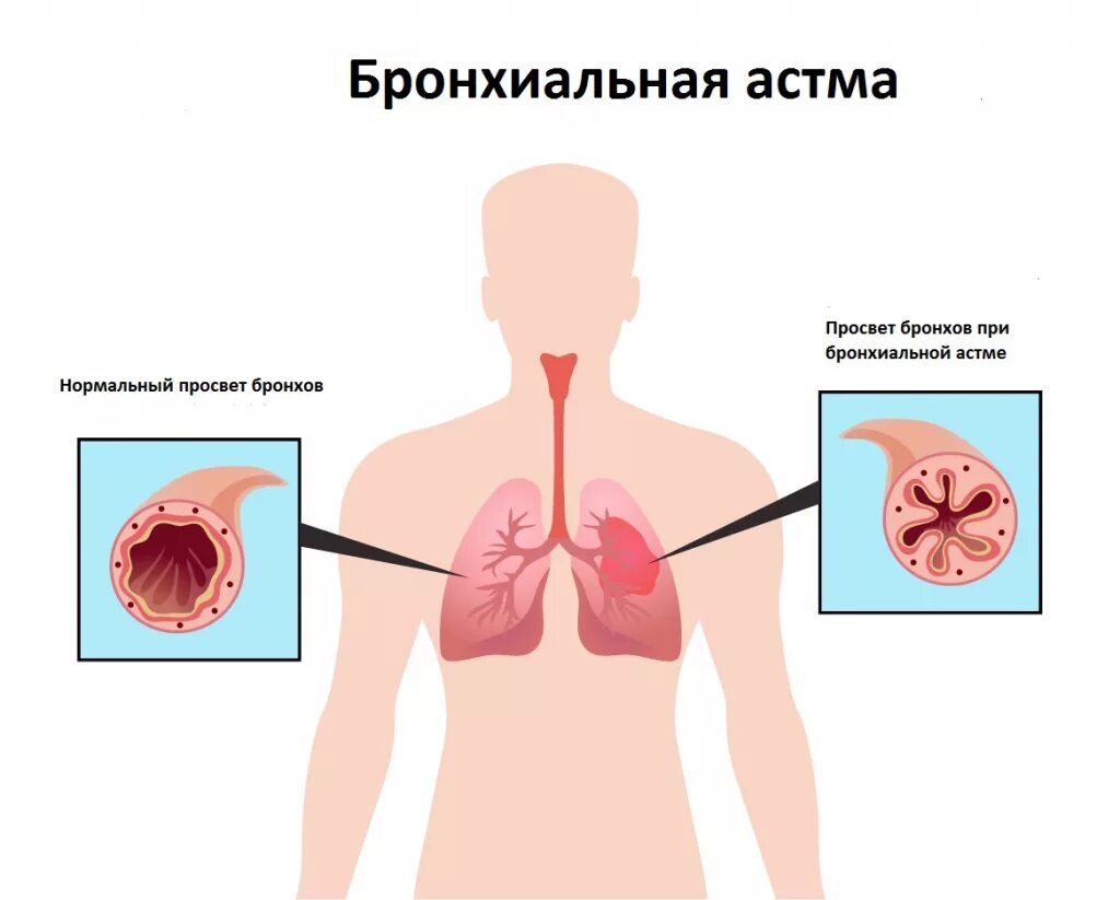 Мокрота лежа. Бронхиальная астма. Бронхиальная астма легкие.