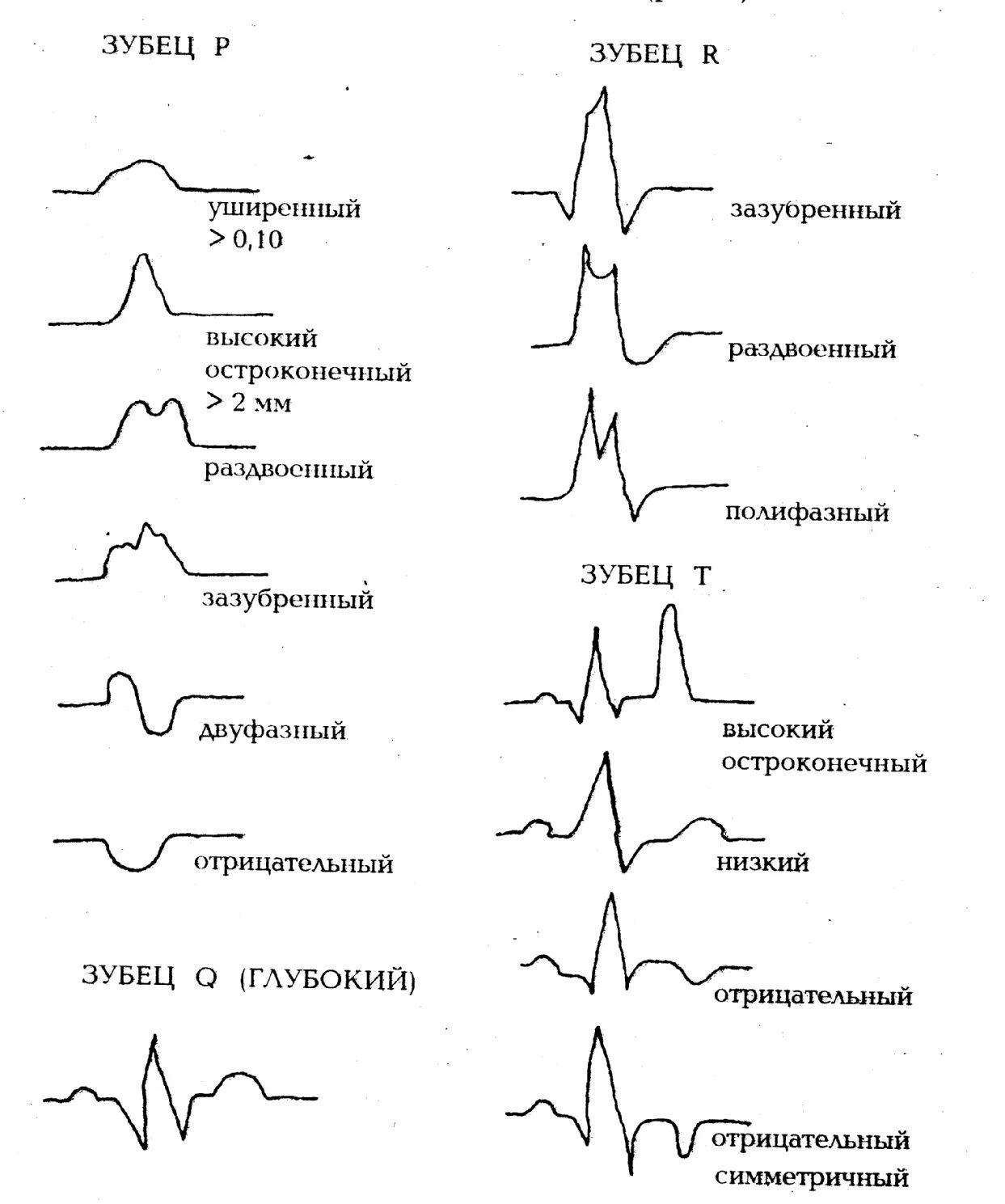 Нарастание зубца r. Комплекс зубцов QRS на ЭКГ. Зубец QRS на ЭКГ норма. Нормы зубцов ЭКГ таблица. Патология зубца r на ЭКГ.