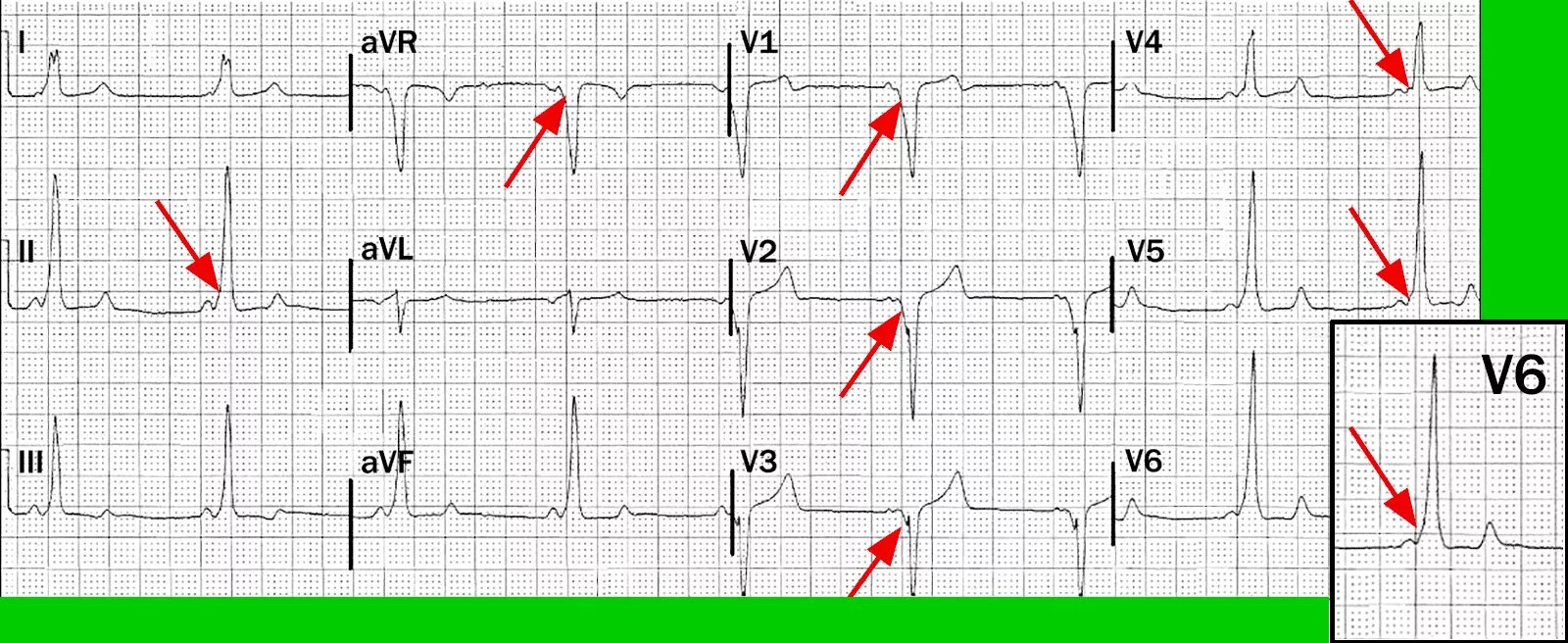 AVR AVL AVF отведения на ЭКГ норма. AVF отведение ЭКГ. Зазубренный зубец s в v1 v2 v3. На ЭКГ нет зубца s v5 v6. Отведение v1 на экг