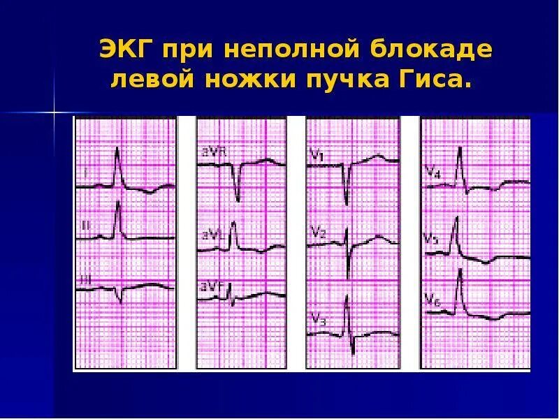 Блокада левой ножки пучка Гиса на ЭКГ. Блокада ветвей левой ножки пучка Гиса на ЭКГ. Блокада левой ножки на ЭКГ. ЭКГ при неполной блокаде правой ножки пучка Гиса.