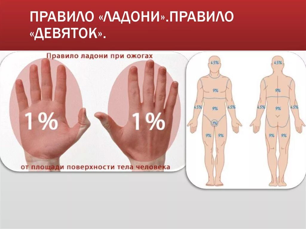 Площадь поражения при ожогах. Правило девяток при ожогах. Метод ладони при ожогах.