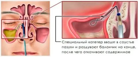 Почему течет левая ноздря