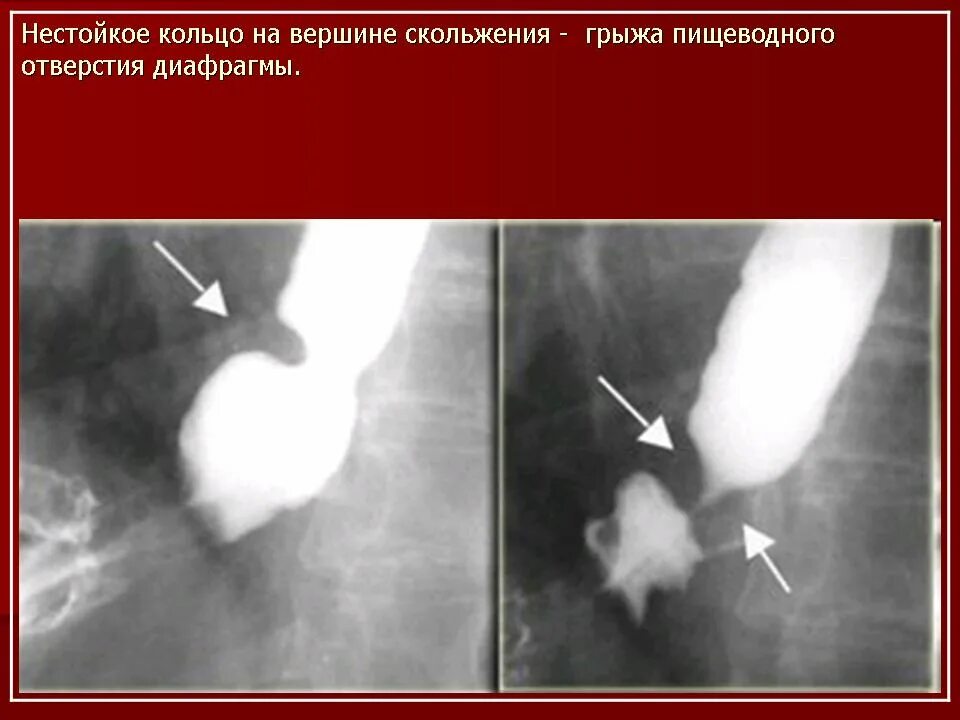 Кольцо шацкого в пищеводе что это. Грыжа пищеводного отверстия диафрагмы и кольцо шацкого. кольцо шацкого в пищеводе рентгенограммы. кольцо шацкого рентген. пищеводное кольцо шацкого.