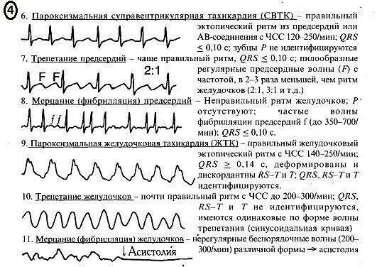 Пароксизмальная тахикардия мерцательная аритмия