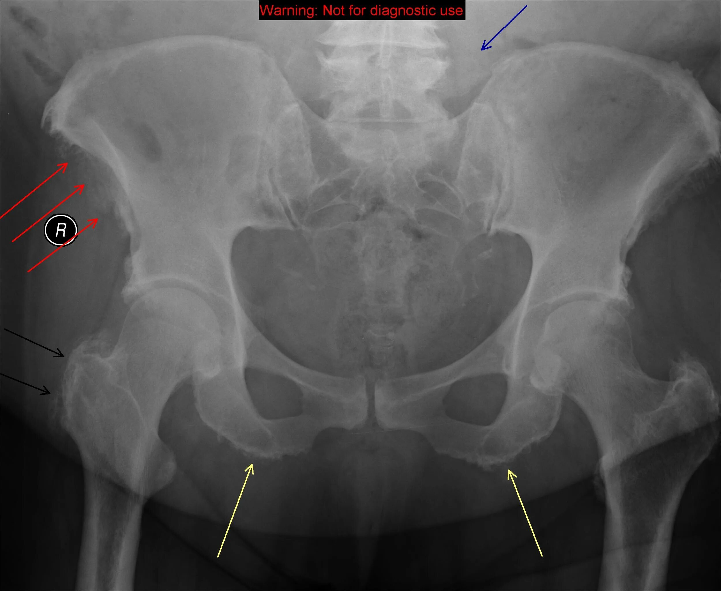 Перелом подвздошной кости рентген. Оссификаты тазобедренного сустава. Тендиноз тазобедренного сустава рентген. Энтезопатия седалищного бугра.