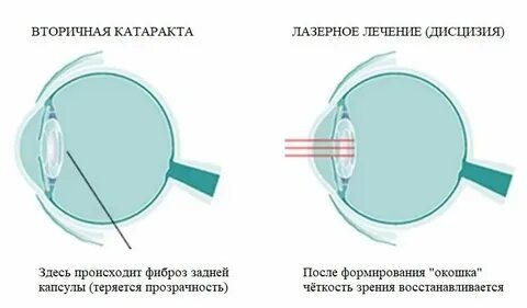 Когда можно за руль после замены хрусталика