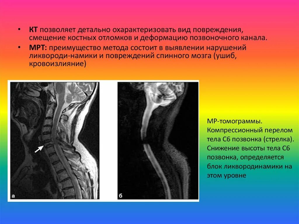 Лучевая диагностика повреждений позвоночника. Лучевая картина повреждений позвоночника и спинного мозга.. Спинной мозг лучевая диагностика. Методы диагностики повреждения позвоночника.