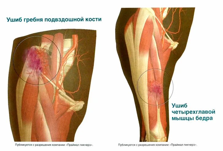 Контузия мышцы бедра с гематомой. Болят кости после операции