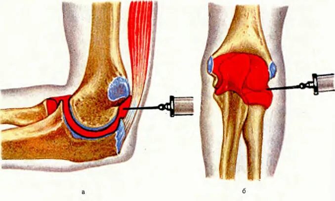 Кровотечение в коленный сустав. Гемартроз кровоизлияние в полость сустава. Геперторз локстевоно сустава. Гемартроз локтевого сустава. Гемартроз коленного пункция.