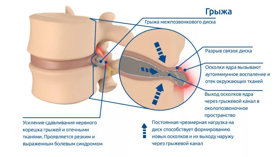 Разрыв диска. Грыжа диска. Межпозвоночная грыжа. Нагрузка на межпозвоночный диск. Грыжа спинного диска.