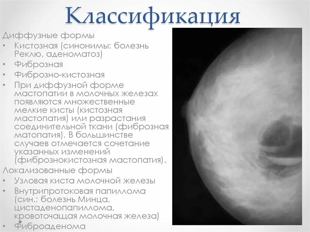 УЗИ Узловая фиброзно-кистозная мастопатия. Фиброзно-кистозная мастопатия молочных желез симптомы. Классификация кист молочной железы. Фиброзно-кистозные изменения молочных желез что это такое. Признаки фиброзных изменений молочных желез