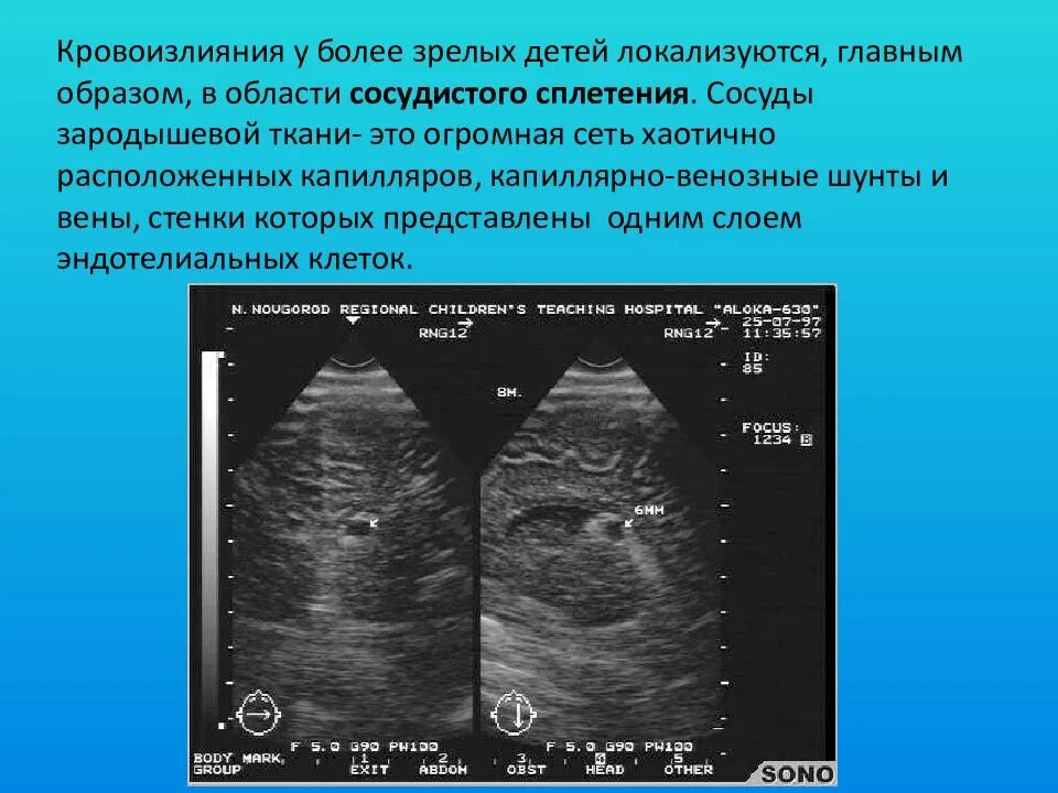 Нейросонография новорожденных кисты сосудистых сплетений. Киста сосудистого сплетения. Киста сосудистого сплетения у плода.