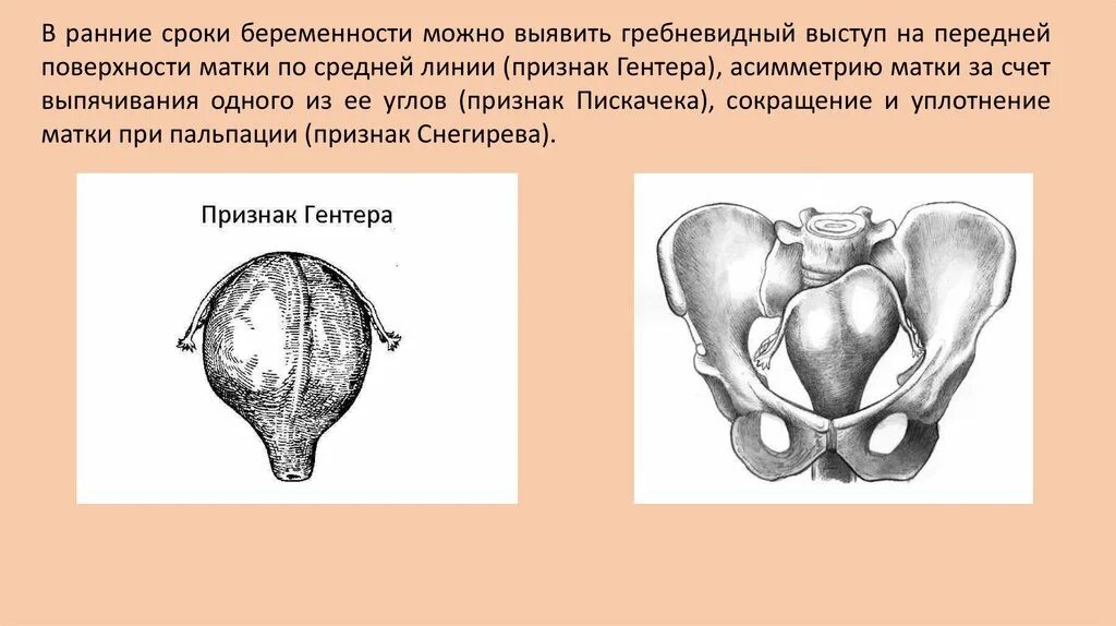 Признак пискачека. Признак Пискачека и Снегирева. Симптомы Пискачека Гентера. Симптом Горвица Гегара Пискачека Гентера.