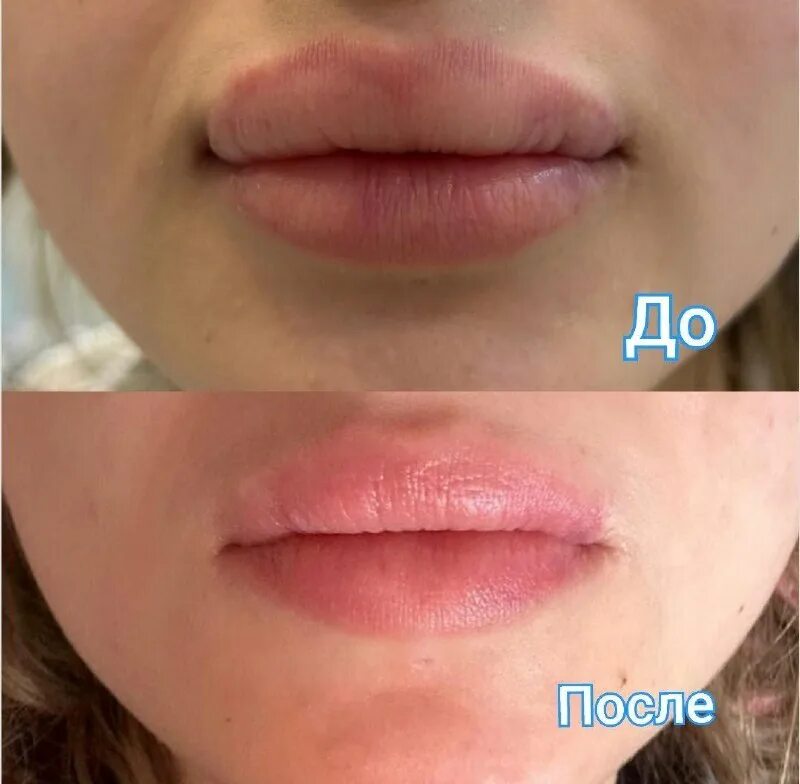 Губы после выведения филлера. Губы после выведения филлера. Введение гиалуронидазы в губы. Увеличение губ курчатов. Губы после выведения филлера.
