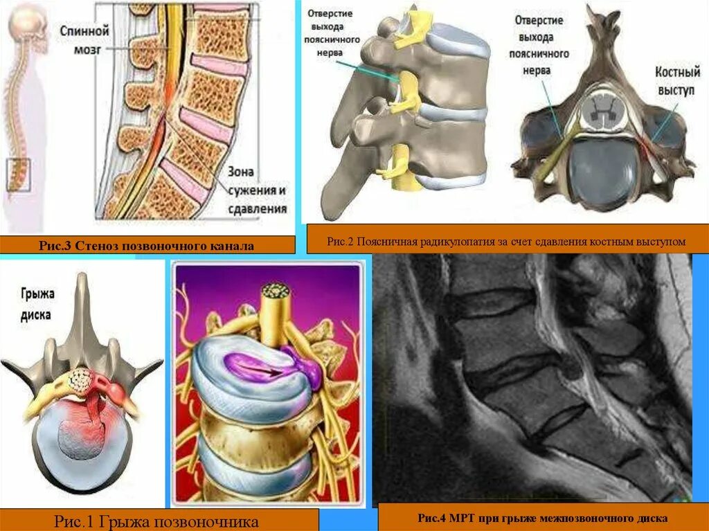 Стеноз позвоночного канала l2-l3. Стеноз межпозвонковых отверстий l2-s1. Сужение межпозвонковых отверстий поясничного отдела l5-s1.