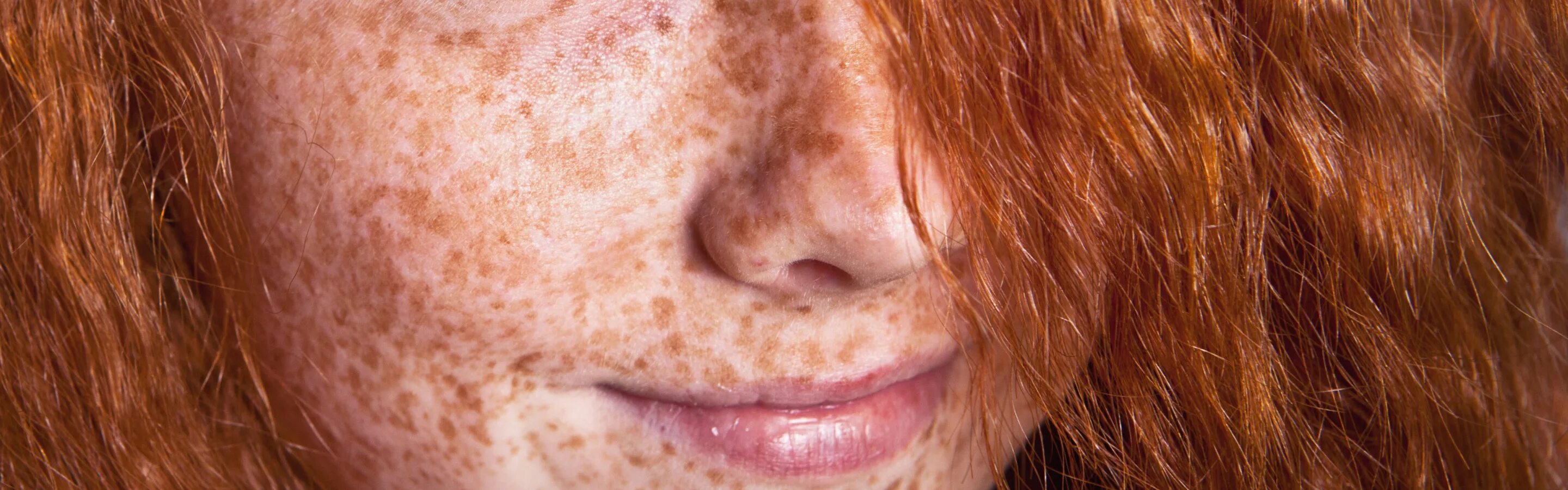 Freckles перевод. Пигментная ксеродерма болезнь. Лентиго, хлоазма, веснушки. Хлоазма,лентиго,мелазма. Наследственное заболевание пигментная ксеродерма.