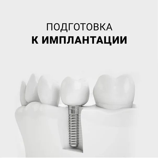 Имплантация как подготовиться