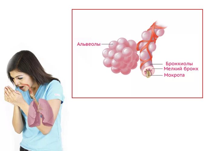 Беспокоит кашель с мокротой. Кашель с мокротой из бронхов. Кашель с мокротой рисунок.
