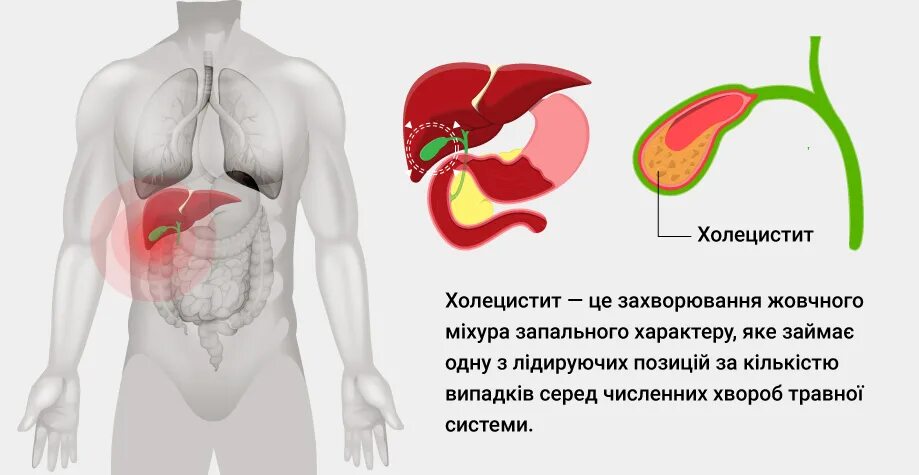 Холецистит желчного пузыря лечение. Хронический холецистит причины. желчный пузырь где находится. расположение желчного пузыря у человека на картинке.