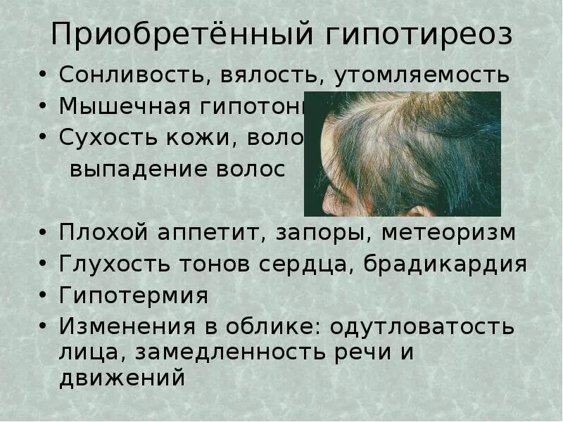 Приобретенный гипотиреоз у детей. Гипотиреоз сонливость. Гипотиреоз выпадение волос. Гипотиреоз сухость кожи.