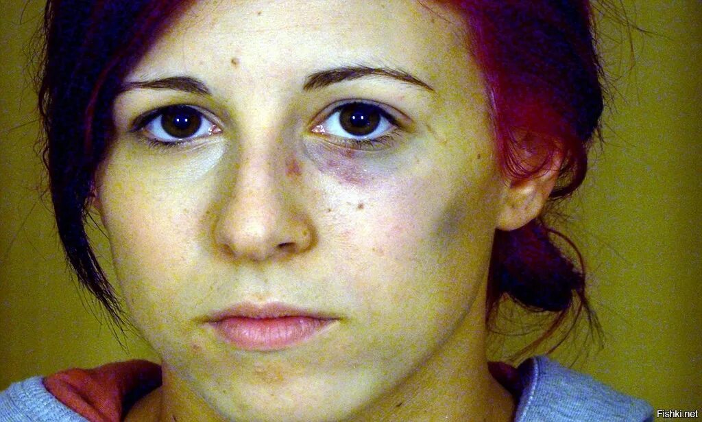 Лицо с синяками под глазами. Девушка с синяками под глазами.