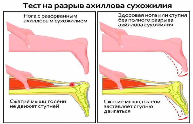Где находится разрыв. Разрыв ахиллова сухожилия. надрыв ахиллова сухожилия. полный разрыв ахиллова сухожилия. разрыв ахиллова сухожилия на ноге.