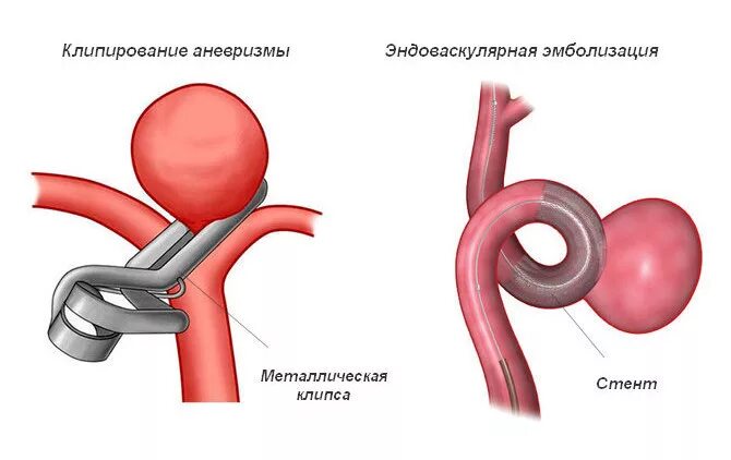 Эндоваскулярное клипирование аневризмы. Васкулярная эмбрлизация аневризмы. Аневризма эндоваскулярная операция. Эндоваскулярная эмболизация аневризмы. Аневризма показания к операции