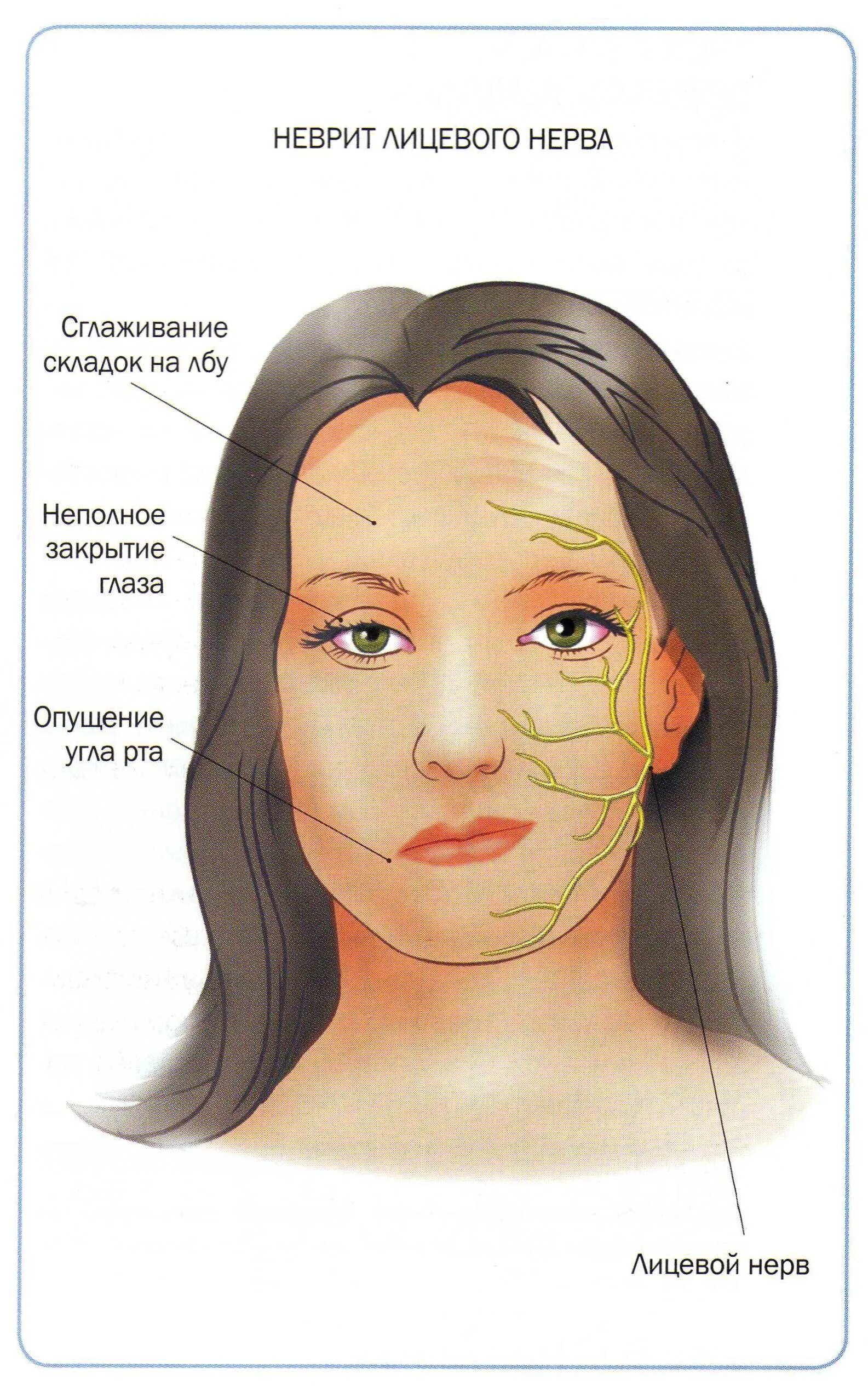 Неврит лицевого нерва. Неврит тройничного нерва. Воспаление тройничного лицевого нерва. Неврит лицевого нерва и тройничного нерва. Неврит лицевого нерва отзывы
