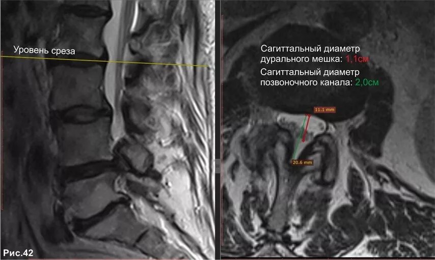 Дуральный мешок позвоночника строение. Деформация переднего контура дурального мешка. Стеноз дурального мешка поясничного отдела. Дуральный мешок деформирован шейный отдел. Компрессия дурального.