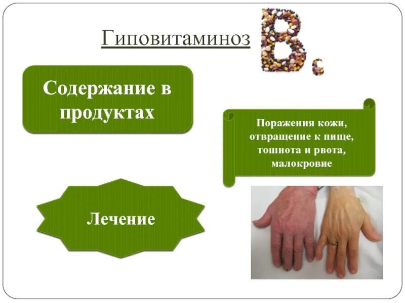 Витамин b3 гиповитаминоз. Витамин в5 гиповитаминоз. Витамин в5 гиповитаминоз. Авитаминоз витамина в5. Витамин в5 гиповитаминоз.