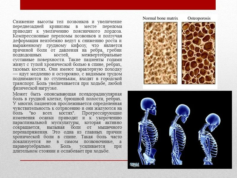 Снижена высота сегментов. Снижена высота тела позвонка. снижение высоты тел позвонков. снижения высоты тела позвоночника. снижение высоты тела позвонка причины.