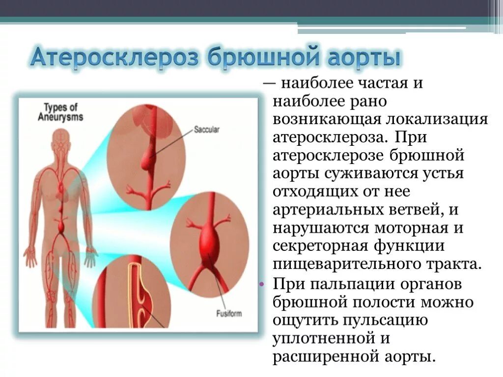 Брюшная ишемия. Атеросклероз брюшного отдела аорты и ее ветвей. Брюшной отдел аорты с признаками атеросклероза. Атеросклероз артерии аорты брюшной полости. Атеросклероз брюшной аорты симптомы.