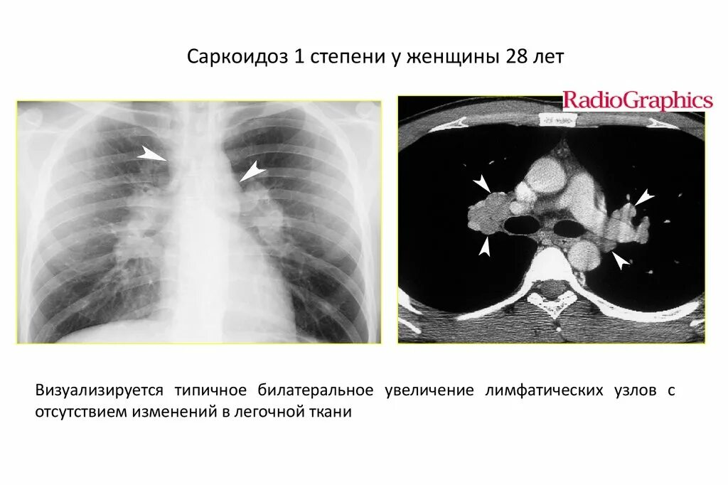 Саркоидоз 1. Саркоидоз 1 стадия рентген. саркоидоз легкого рентген. саркоидоз рентген 4 стадия.