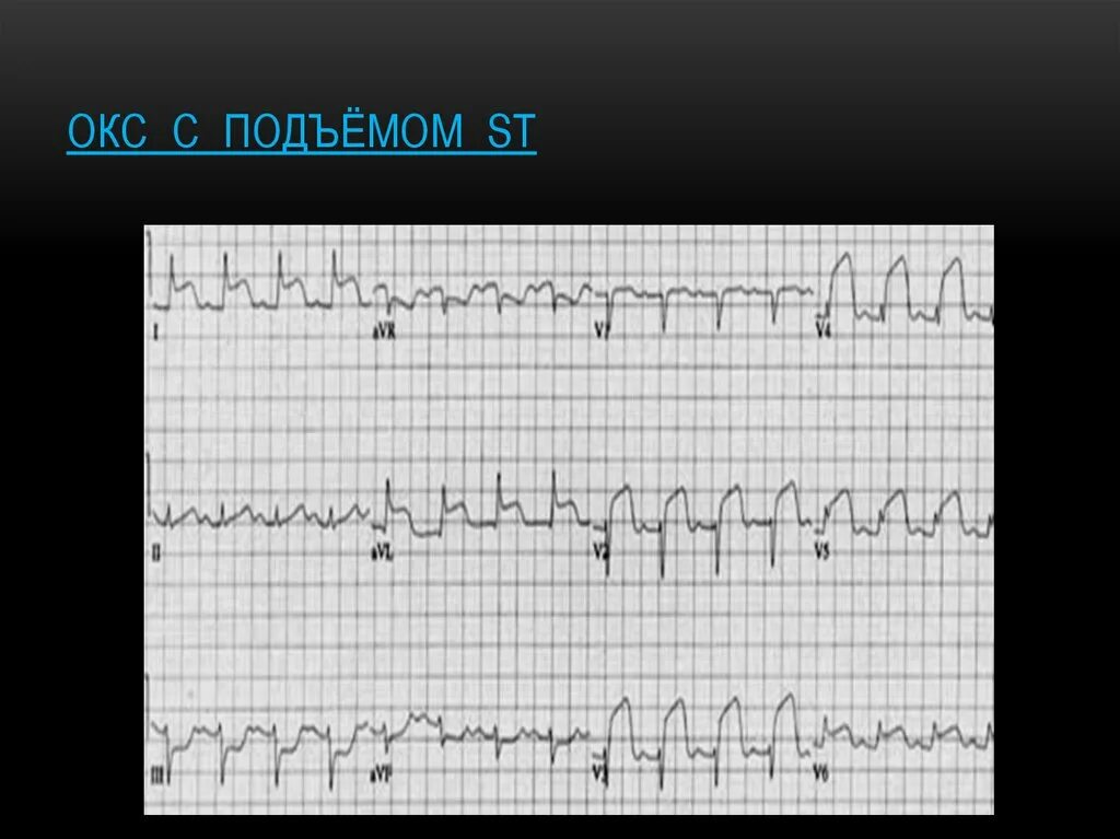 Без подъема st на экг. ЭКГ при инфаркте миокарда без подъема St. Окс c подъемом сегмента St ЭКГ. ЭКГ при Окс с подъемом St. Окс без подъема St на ЭКГ.