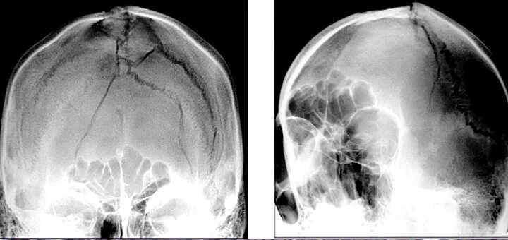 Трещина в голове. Оскольчатый перелом черепа рентген. Оскольчатый перелом чере. Перелом свода черепа рентген. Оскольчатый перелом свода черепа.