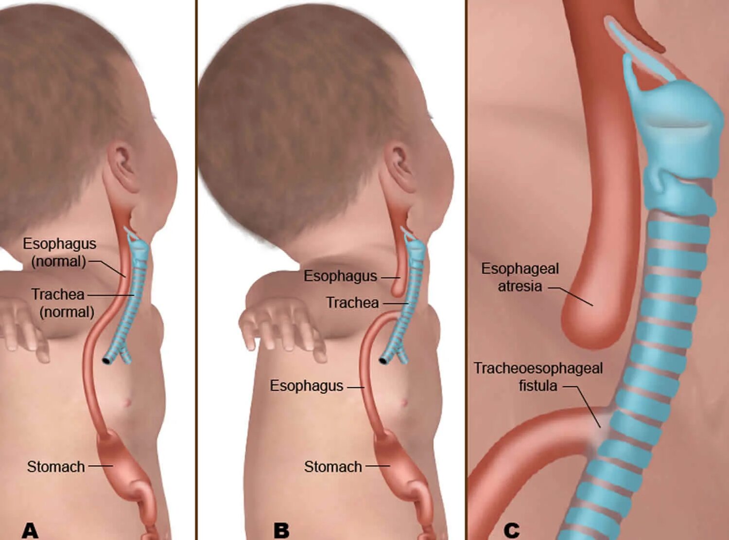 Атрезия пищевода у новорожденных операция. Атрезия пищевода хирургия. Атрезия свищевая у новорожденных. Пищевод у новорожденного