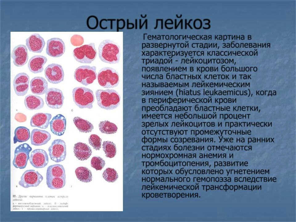 Острый лейкоз бластные клетки. Бластные клетки в крови при лейкозе. Бластные клетки хронический лейкоз. Бластные клетки 88% в крови.