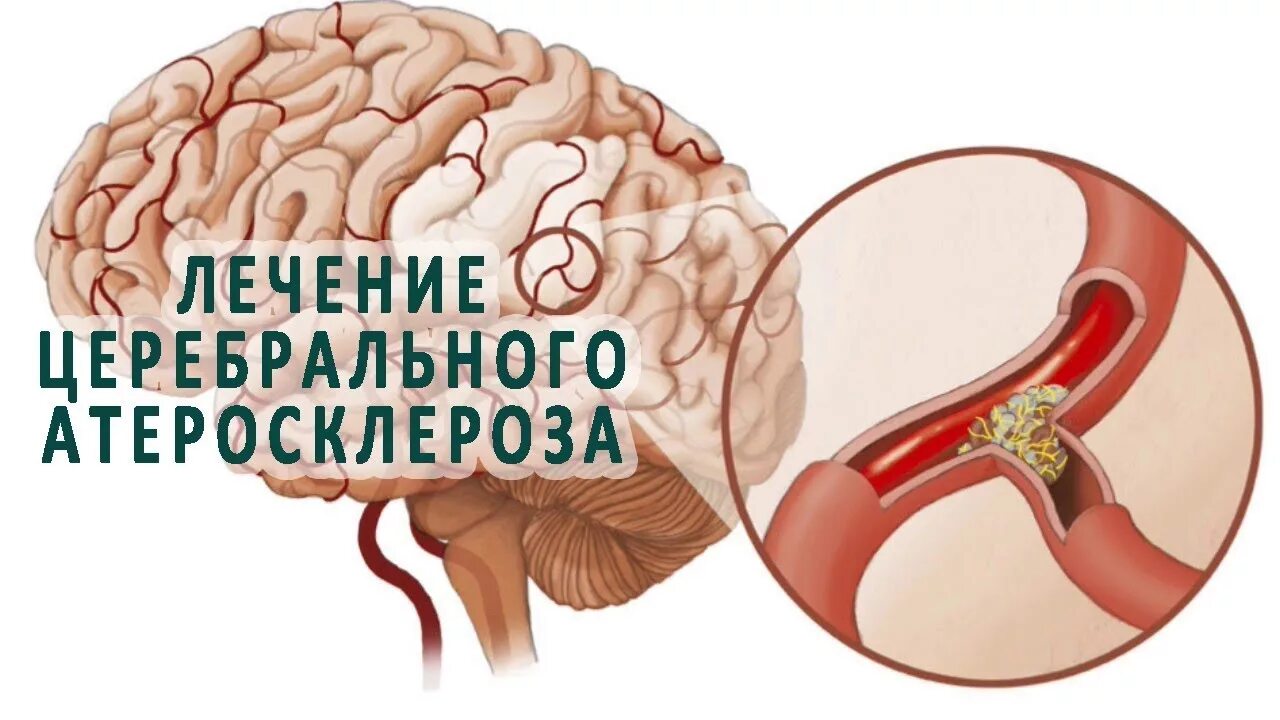 Бляшка в головном мозге