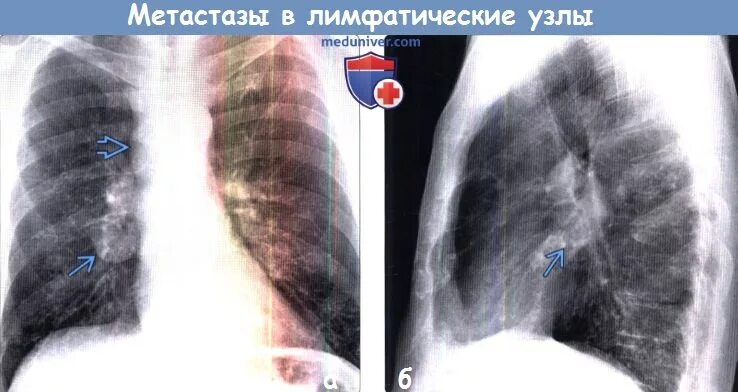Рентген грудной клетки метастазы. Метастазы в лимфоузлы рентген. Метастазы во внутригрудные лимфоузлы. Лимфоузлы на рентгене легких. Метастазы в легких лимфоузлы