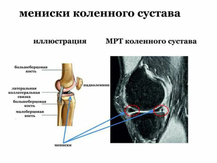 Мрт коленного сустава времени. Мрт мениска коленного сустава. анатомия менисков коленного сустава мрт. мрт мениска коленного сустава снимок. мрт коленного сустава расшифровка.