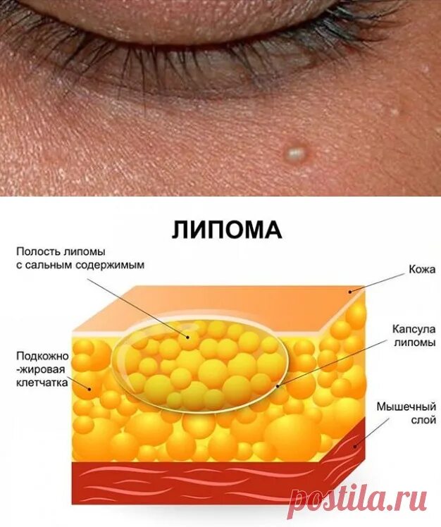 Подкожный жировик на лице. Капсула жировика