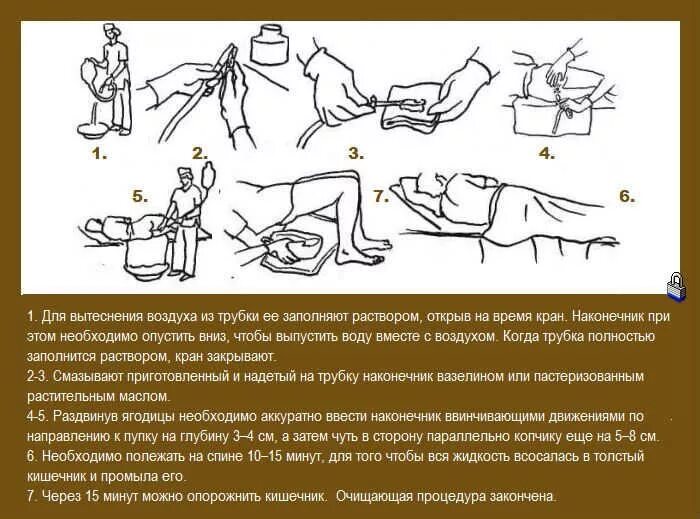 Можно ли сделать клизму. Схема очищения кишечника клизмой. Правильная поза для клизмы. Поза для клизмы в домашних. Очистительная клизма.