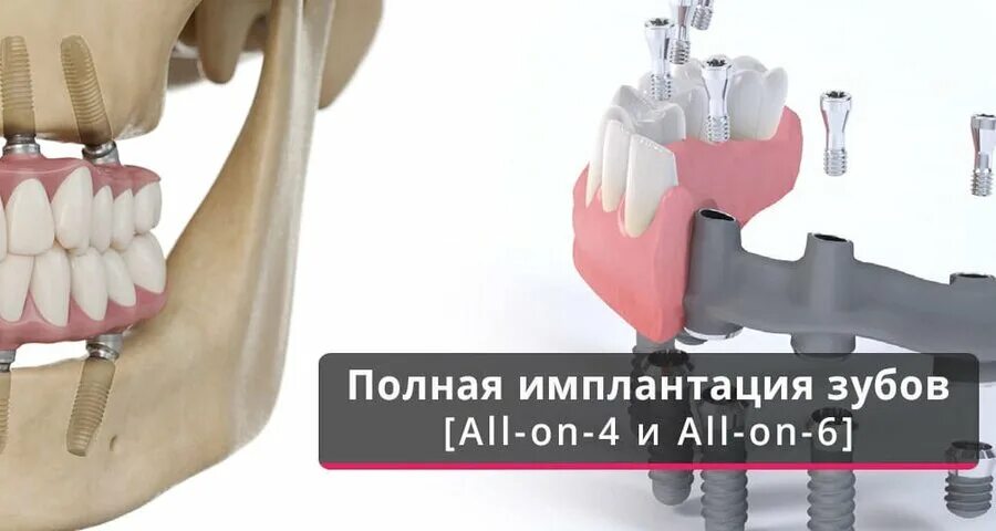 Имплантация sup aznona com. Имплантация зубов all on 4. (Метод имплантации all-on-4)методы. Имплантация челюсти на 4 имплантах.