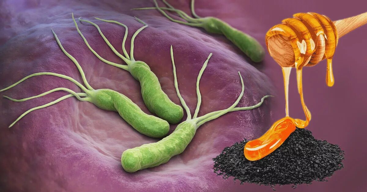 Мед хеликобактер. Ассоциация с h. pylori характерна:. Бактерия хеликобактер пилори в желудке симптомы. Хеликобактер пилори ударение.