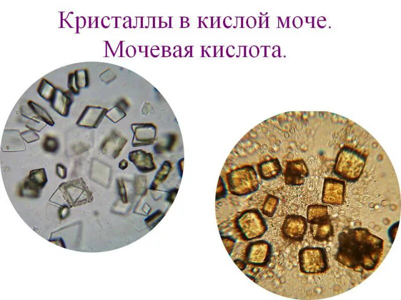 Что значит кристаллы в моче у женщины. Кристаллы мочевой кислоты микроскопия. соли мочевой кислоты в моче микроскопия. мочевая кислота микроскопия мочи. соли мочевой кислоты микроскопия.