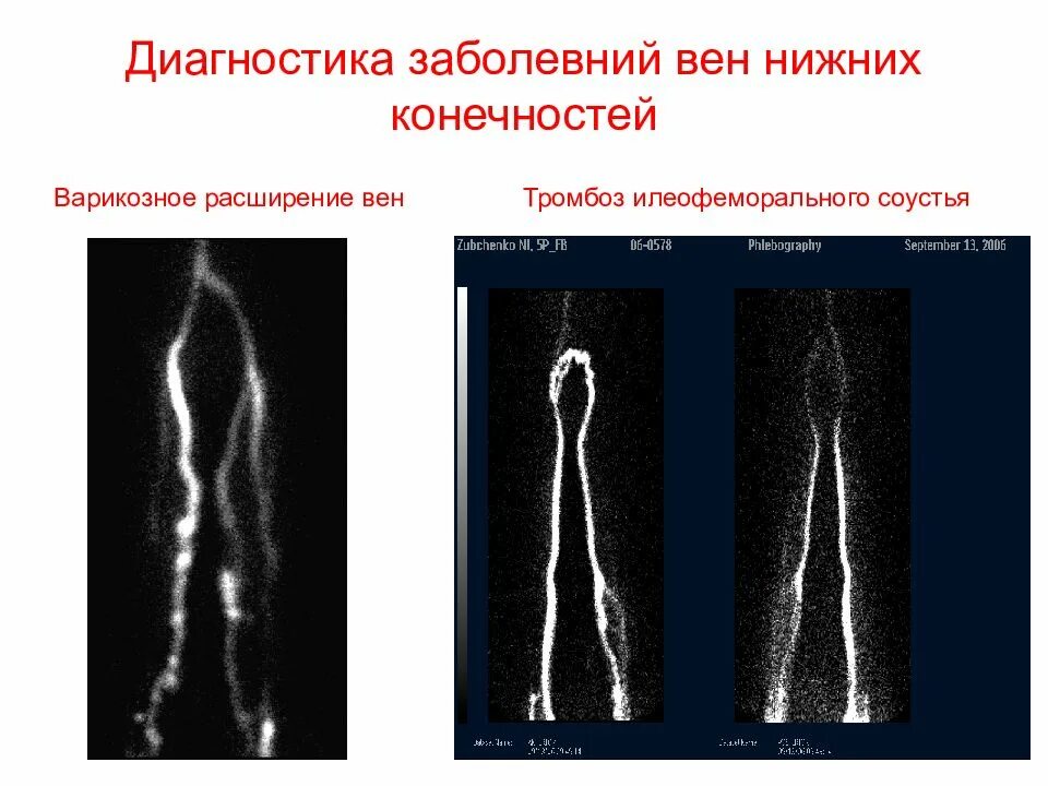 Флебография вен нижних конечностей. Торсионный профиль нижних конечностей на кт. Варикозное расширение вен нижних конечностей диагностика. Мрт сосудов нижних конечностей. Диагноз тромб