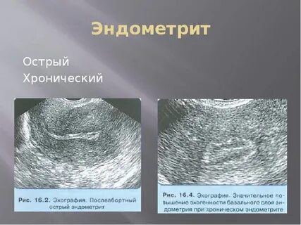 Эндометрия при мирене