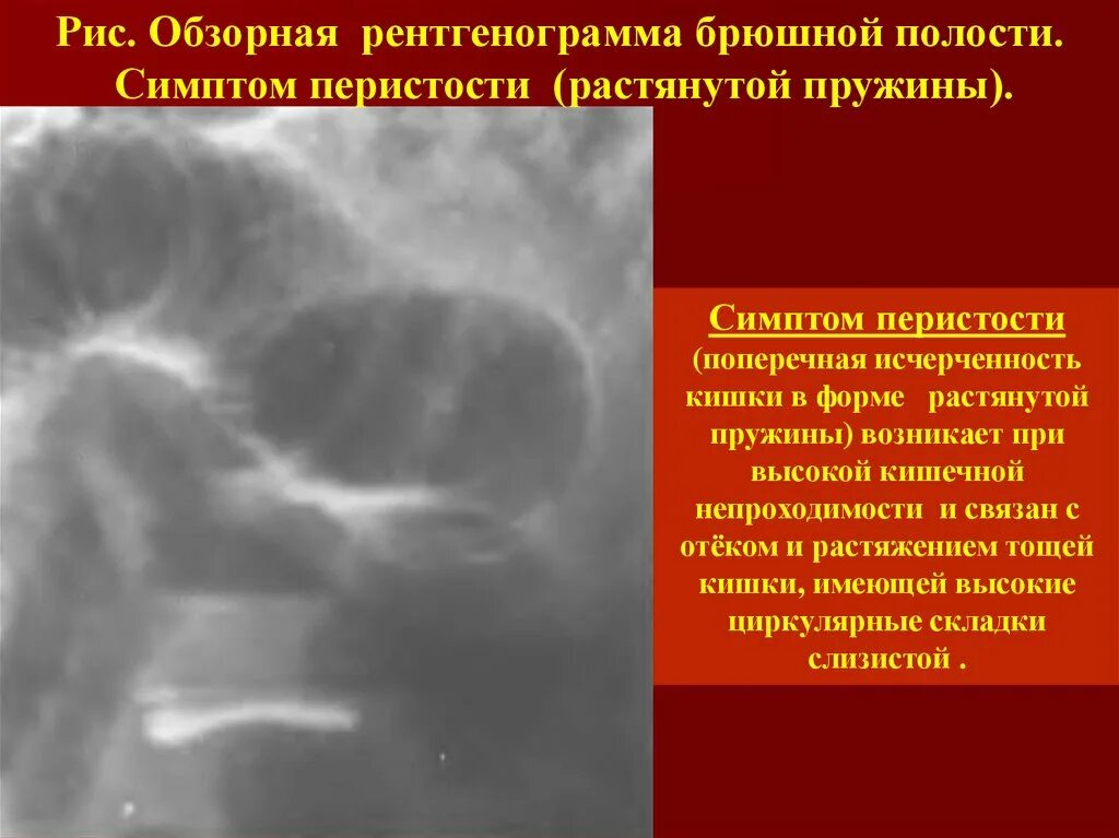 В тонкой кишке складки керкринговы тонкой. Кишечная непроходимость симптомы рентген. Инвагинация толстого кишечника рентген. Перистость тонкой кишки рентген. Чаши клойбера в толстой кишке.