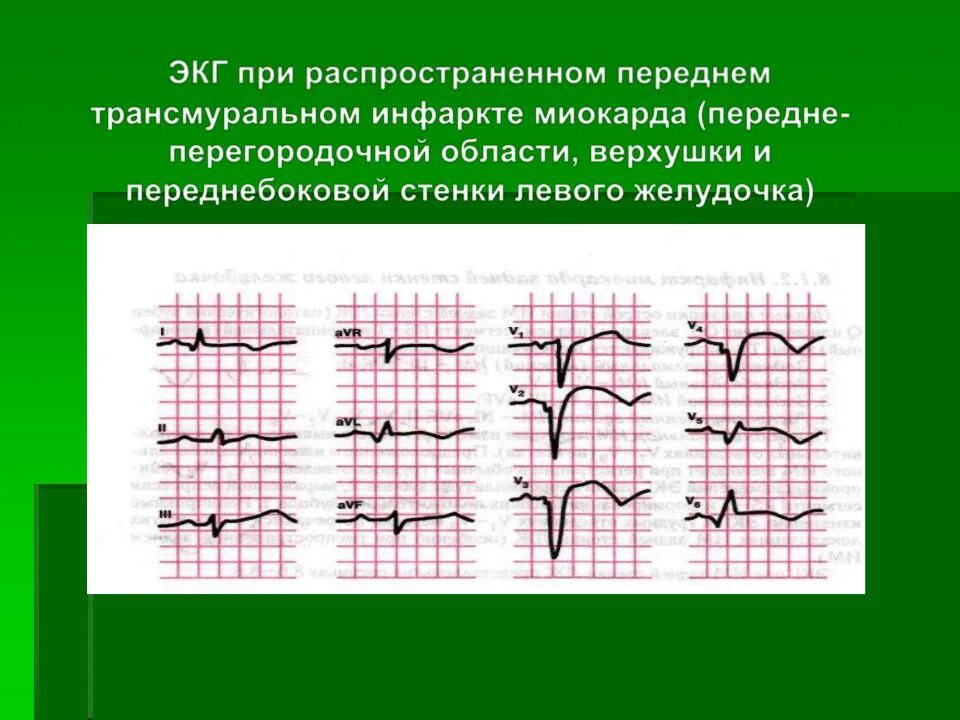 Острый распространенный передний инфаркт миокарда ЭКГ ЭКГ. Острый передне перегородочный инфаркт ЭКГ. Инфаркт миокарда трансмуральный передне перегородочный. Передний трансмуральный инфаркт миокарда ЭКГ.